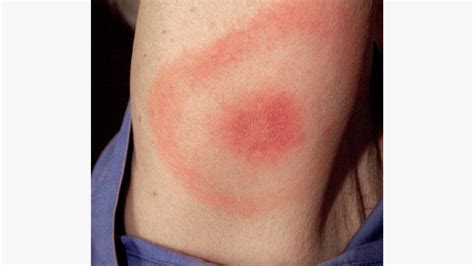 Allergic Reaction To Tick Bites