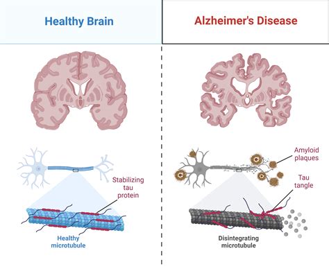 Can Lifestyle Changes Protect The Brain From Alzheimer S A New Study Offers Hope For Prevention The Boston Globe
