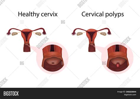 Cervical Polyps