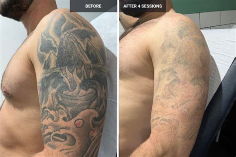 Laser Tattoo Before And After: Quick Fixes For Fast Results