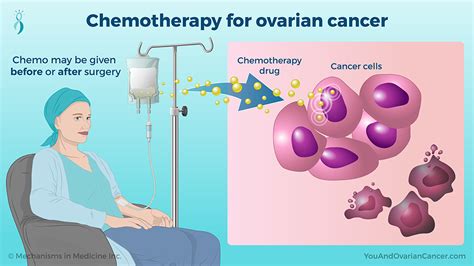 Ovarian Cancer And Chemotherapy