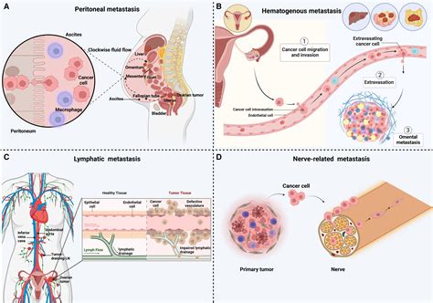 Ovarian Cancer Metastasis Looking Beyond The Surface Cancer Cell