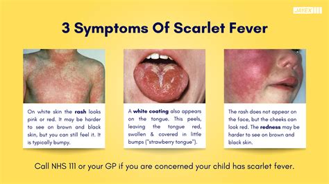 Key Facts About Slap Virus Vs Scarlet Fever